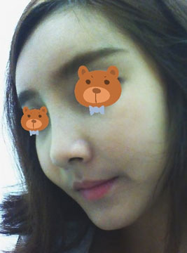 非手術(shù)隆鼻費用一般需要多少錢,非手術(shù)隆鼻前的注意事項