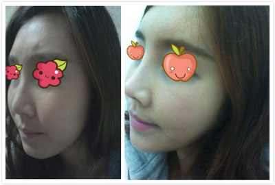 非手術(shù)隆鼻費用一般需要多少錢,非手術(shù)隆鼻前的注意事項