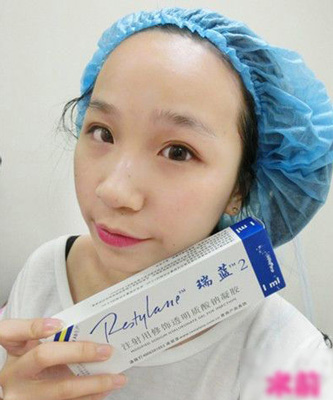 注射打玻尿酸隆鼻前后對比果照片圖 注射打玻尿酸隆鼻可以能夠維持多久