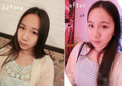 注射打玻尿酸隆鼻前后對比果照片圖 注射打玻尿酸隆鼻可以能夠維持多久