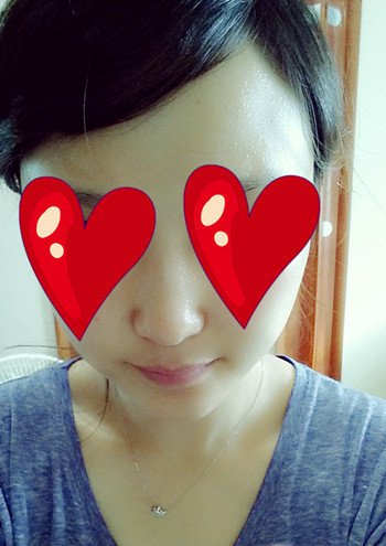 注射打玻尿酸隆鼻前后對比果照片圖 注射打玻尿酸隆鼻可以能夠維持多久