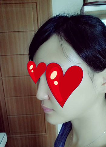 注射打玻尿酸隆鼻前后對比果照片圖 注射打玻尿酸隆鼻可以能夠維持多久