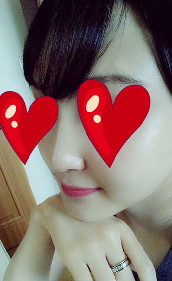 注射打玻尿酸隆鼻前后對比果照片圖 注射打玻尿酸隆鼻可以能夠維持多久