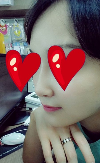 注射打玻尿酸隆鼻前后對比果照片圖 注射打玻尿酸隆鼻可以能夠維持多久