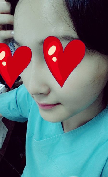 注射打玻尿酸隆鼻前后對比果照片圖 注射打玻尿酸隆鼻可以能夠維持多久