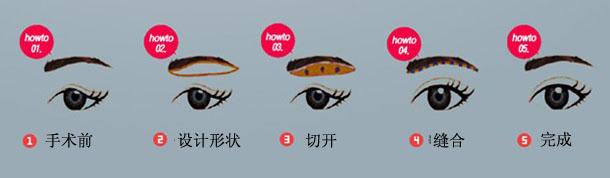 做切眉術降低風險嗎 切眉術風險大不大