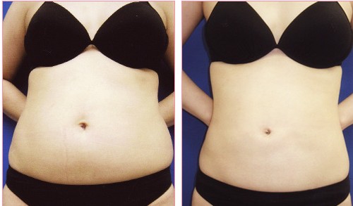 哪些人不能做腰腹吸脂手術(shù) 腰腹吸脂手術(shù)后如何護理