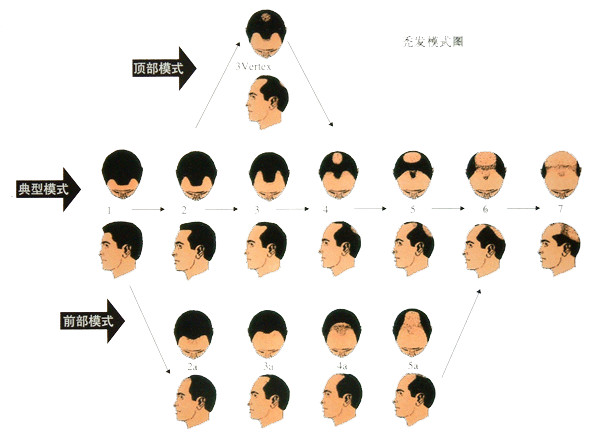 植發(fā)手術(shù)果