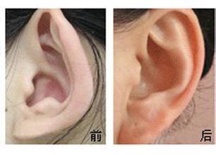 杯狀耳怎么矯正 杯狀耳矯正術(shù)的適應(yīng)癥