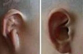 選擇隱耳整形有什么優(yōu)勢呢？