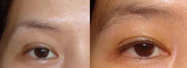 眉毛整形對比果照片圖