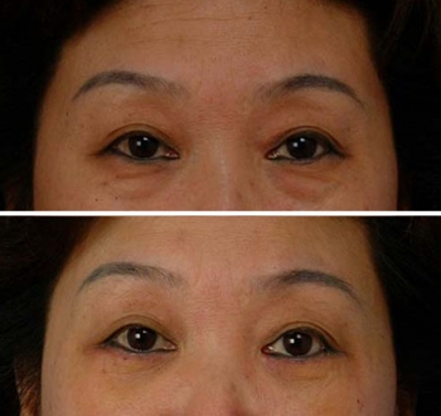 眉毛整形對比果照片圖