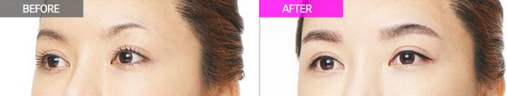 眉毛整形對比果照片圖