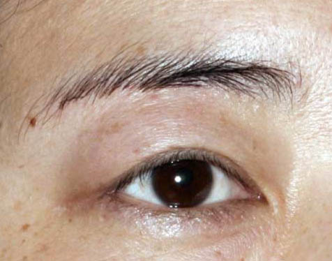 眉毛整形前后對比