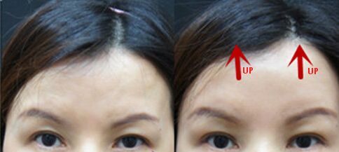 眉毛整形前后對比