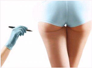 吸脂后,為什么,凹凸不平,如何修復(fù)