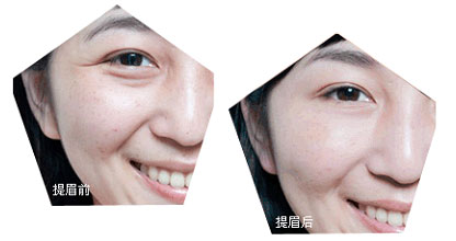 提眉切眉術(shù)前的注意事項(xiàng)