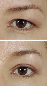 提眉切眉術(shù)前的注意事項(xiàng)