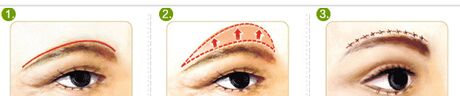 切眉手術(shù)前后對(duì)比照片