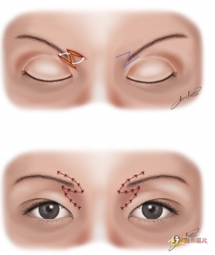 切眉手術(shù)前后對(duì)比照片