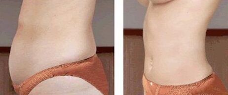 多大年齡可以做腰腹吸脂手術(shù)