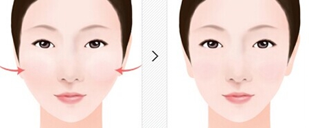 廣州曙光醫(yī)學(xué)美容醫(yī)院,顴骨手術(shù),怎么樣,多少錢