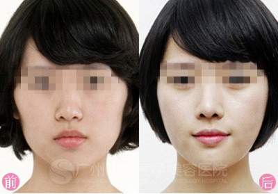 廣州曙光醫(yī)學(xué)美容醫(yī)院,顴骨手術(shù),怎么樣,多少錢