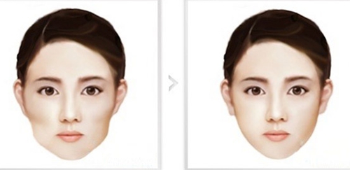 廣州曙光醫(yī)學(xué)美容醫(yī)院,顴骨手術(shù),怎么樣,多少錢