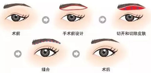 切眉術手術過程