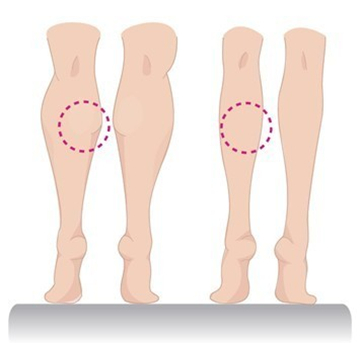腰腹吸脂,大概,多少錢