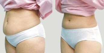 腰腹吸脂手術(shù)后會不會留疤