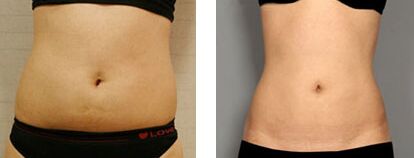 腹部吸脂都適合哪些人