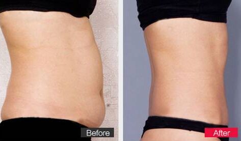 腰腹吸脂手術(shù)不適合哪些人