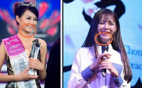 沈夢(mèng)辰整容對(duì)比圖 下巴塞的假體被發(fā)現(xiàn)