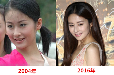 穎兒疑因整容失敗導(dǎo)致嘴部歪斜