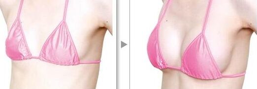 廣州粵美整形美容醫(yī)院隆胸價(jià)格表爆出