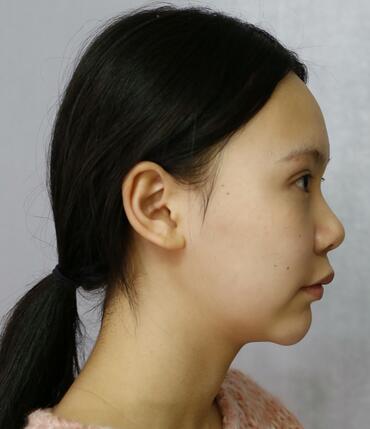 成都天使之翼做隆鼻整形改變了我的塌鼻子 果真的很不錯(cuò)