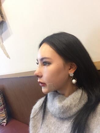 成都天使之翼做隆鼻整形改變了我的塌鼻子 果真的很不錯(cuò)