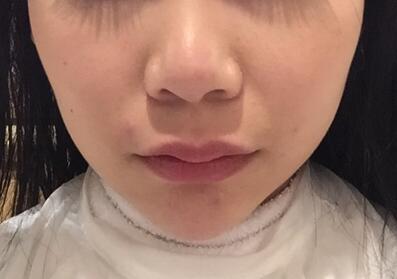 成都天使之翼做隆鼻整形改變了我的塌鼻子 果真的很不錯(cuò)