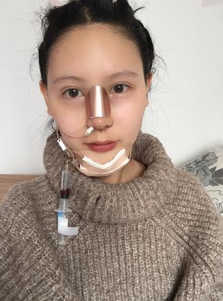 成都天使之翼做隆鼻整形改變了我的塌鼻子 果真的很不錯(cuò)