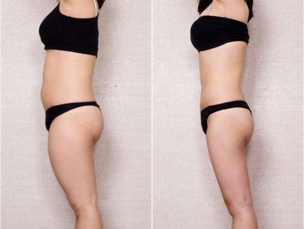 北京吸脂多少錢