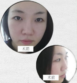 埋線雙眼皮修復(fù)+鼻部修復(fù)歷程