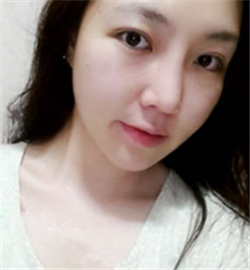 埋線雙眼皮修復(fù)+鼻部修復(fù)歷程