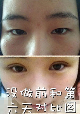 全切雙眼皮十天啦~來看看我的果