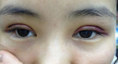 全切雙眼皮十天啦~來看看我的果