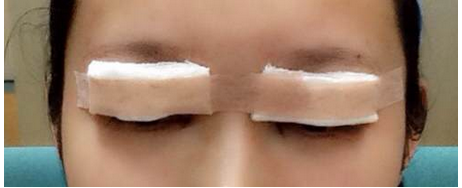 全切雙眼皮去皮去脂開眼角恢復(fù)過(guò)程