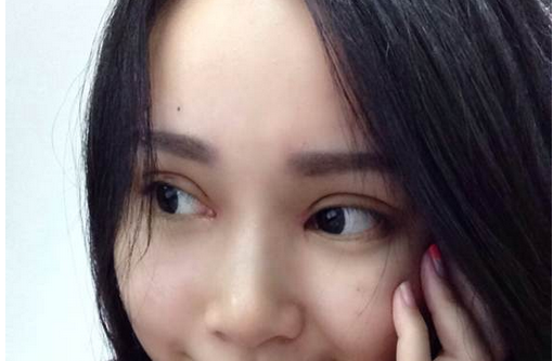 全切雙眼皮+去皮去脂+開眼角一個(gè)月了~