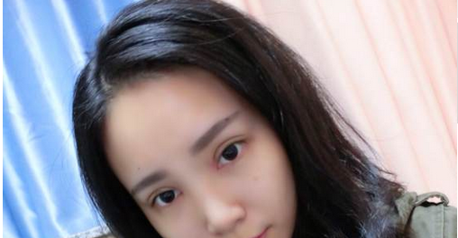 全切雙眼皮+去皮去脂+開眼角一個(gè)月了~