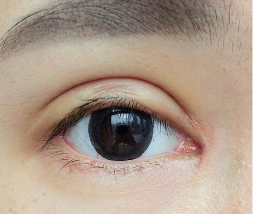 全切雙眼皮+去皮去脂+開眼角一個(gè)月了~