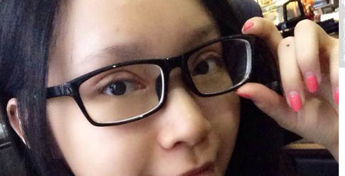 全切雙眼皮+去皮去脂+開眼角一個(gè)月了~